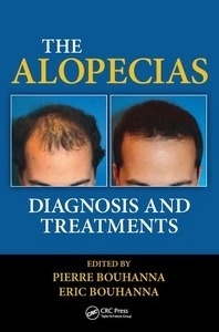 The Alopecias "Diagnosis and Treatments"