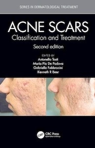 Acne Scars "Classification and Treatment"