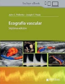 Ecografía Vascular