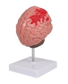 Modelo Patologías Cerebrales (C711)